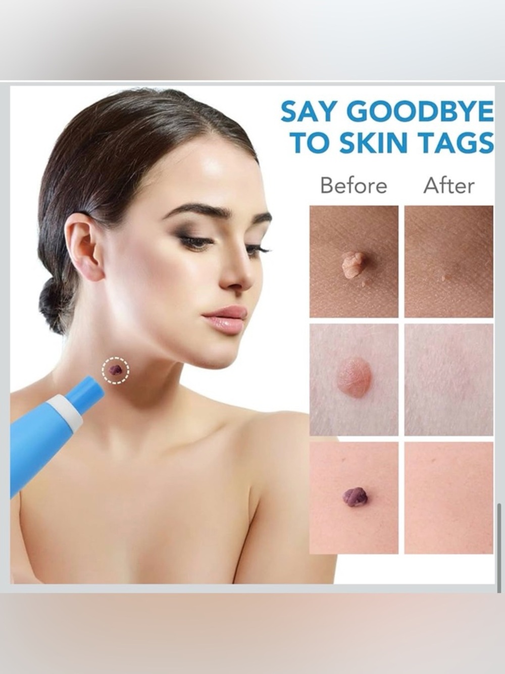 Skin Tag Remover Device FDA-Cleared Safe and Effective Skin Tag Removal Kits - Picture 5 of 7